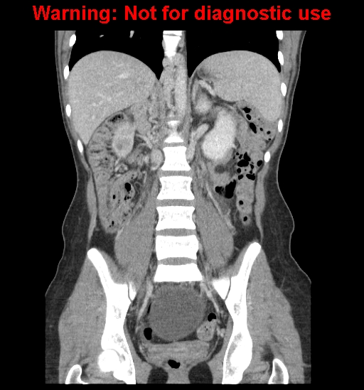 Borderline mucinous cystadenoma of ovary (Radiopaedia 25586-25767 B 42).jpg