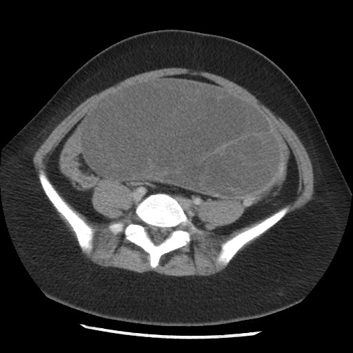 File:Borderline mucinous tumor (ovary) (Radiopaedia 78228-90808 A 108).jpg
