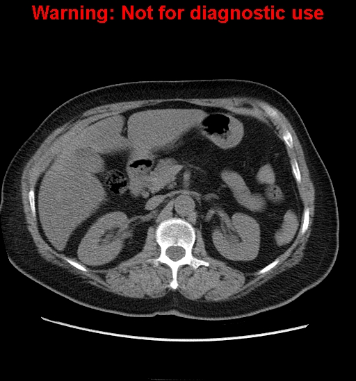 File:Bosniak renal cyst - type II (Radiopaedia 23404-23468 Axial non-contrast 10).jpg