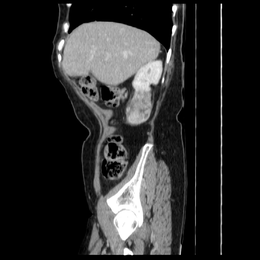 Bosniak renal cyst - type IV (Radiopaedia 22929-22953 G 15).jpg
