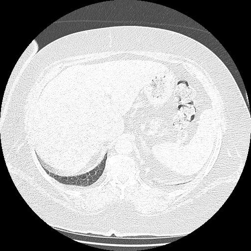 Bovine aortic arch - right internal mammary vein drains into the superior vena cava (Radiopaedia 63296-71875 Axial lung window 171).jpg