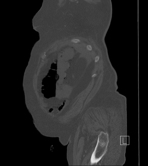 Bowel ischemia secondary to SMA occlusion with extensive portomesenteric venous gas (Radiopaedia 54656-60871 Sagittal bone window 104).jpg
