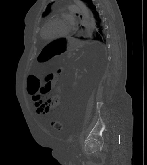 Bowel ischemia secondary to SMA occlusion with extensive portomesenteric venous gas (Radiopaedia 54656-60871 Sagittal bone window 34).jpg