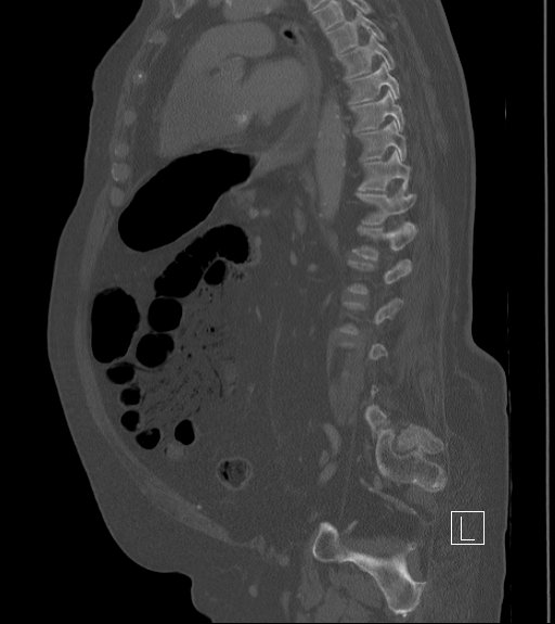Bowel ischemia secondary to SMA occlusion with extensive portomesenteric venous gas (Radiopaedia 54656-60871 Sagittal bone window 44).jpg