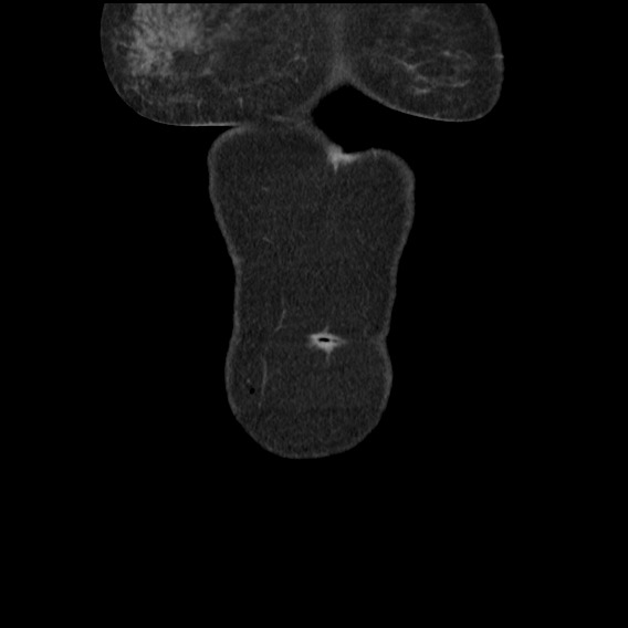 Bowel perforation at ERCP (Radiopaedia 59094-66394 A 5).jpg