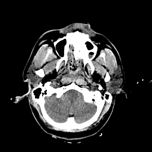 File:Brain contusions, internal carotid artery dissection and base of skull fracture (Radiopaedia 34089-35339 Axial non-contrast 17).png