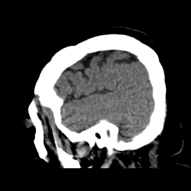 Brain cortical laminar necrosis (Radiopaedia 25822-25971 non-contrast 11).jpg
