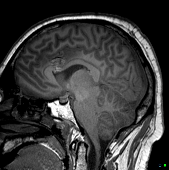 Brain death on MRI and CT angiography (Radiopaedia 42560-45689 Sagittal T1 20).jpg