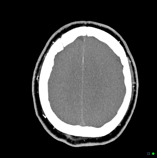 Brain death on MRI and CT angiography (Radiopaedia 42560-45841 B 13).jpg