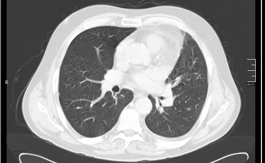 File:Brain metastases from squamocellular lung cancer (Radiopaedia 56515-63219 Axial lung window 35).jpg