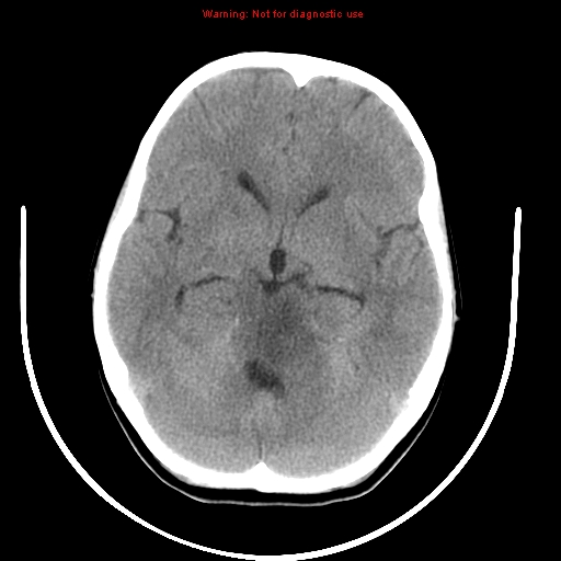 File:Brainstem glioma (Radiopaedia 9444-10123 non-contrast 8).jpg
