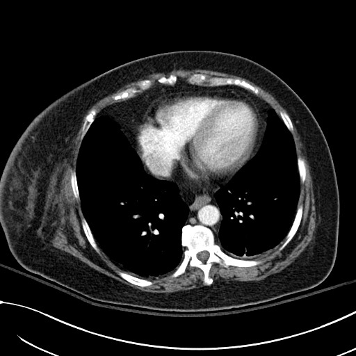 File:Breast carcinoma with pathological hip fracture (Radiopaedia 60314-67974 A 38).jpg