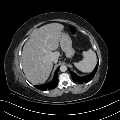 File:Breast carcinoma with pathological hip fracture (Radiopaedia 60314-67974 B 14).jpg