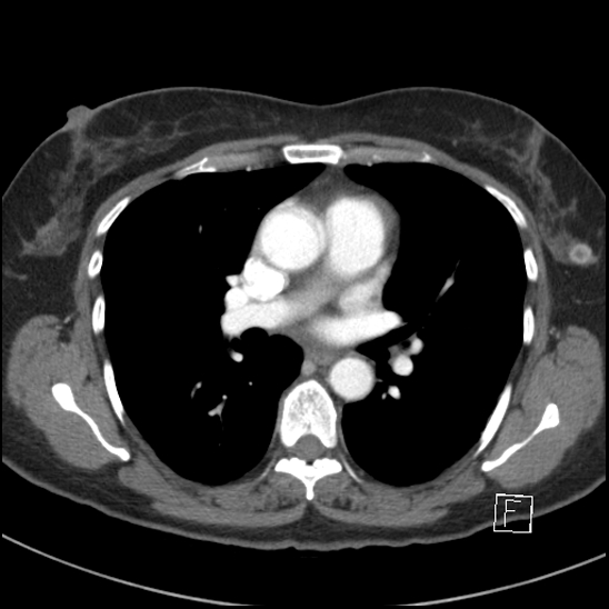 Breast metastases from renal cell cancer (Radiopaedia 79220-92225 A 45).jpg