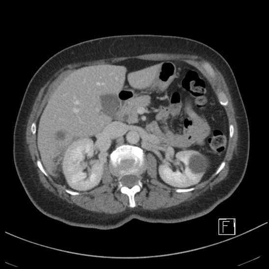 File:Breast metastases from renal cell cancer (Radiopaedia 79220-92225 C 33).jpg