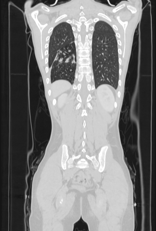 Bronchial carcinoid tumor (Radiopaedia 57187-64090 Coronal lung window 91).jpg
