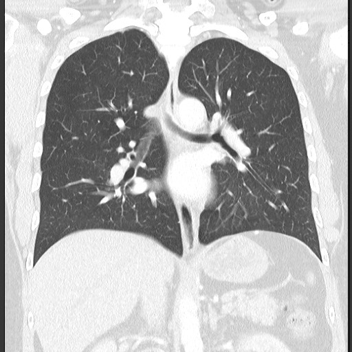 Bronchial carcinoid tumor (Radiopaedia 67377-76764 Coronal lung window 40).jpg