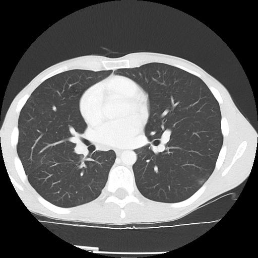 Bronchial carcinoid tumor causing right lower lobe collapse (Radiopaedia 83495-98594 Axial lung window 28).jpg