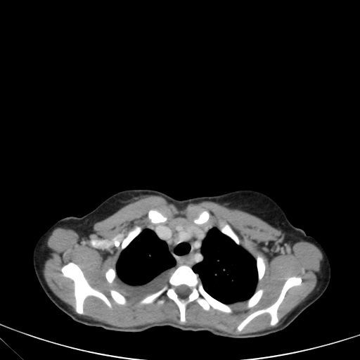 Bronchial mucoepidermoid carcinoma (Radiopaedia 57023-63895 Axial 23).jpg