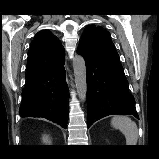 Bronchial stenosis - lung transplant (Radiopaedia 73133-83848 Coronal non-contrast 46).jpg
