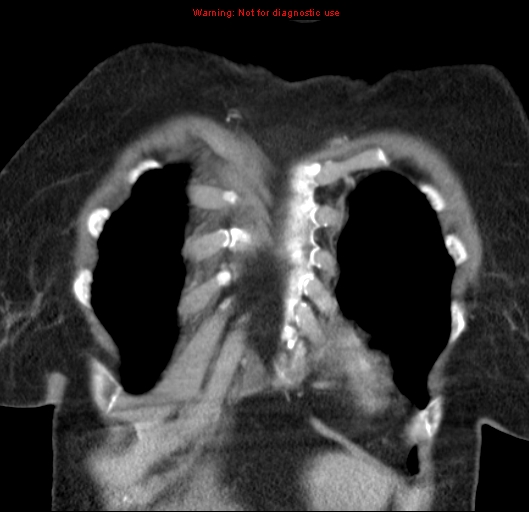 Bronchoalveolar carcinoma (BAC) (Radiopaedia 13436-13392 E 8).jpg
