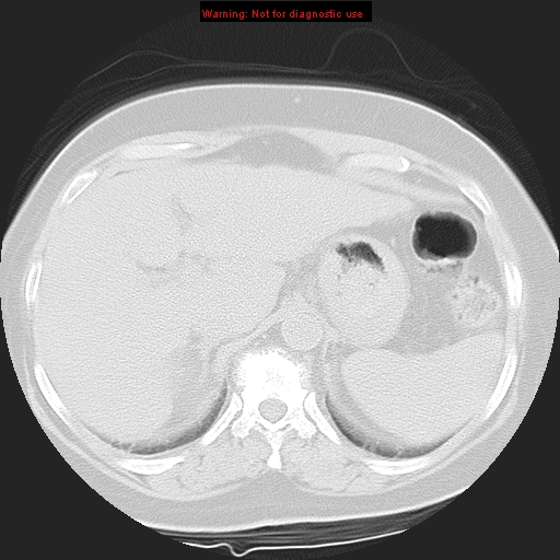 Bronchoalveolar carcinoma (Radiopaedia 13224-13233 Axial lung window 45).jpg