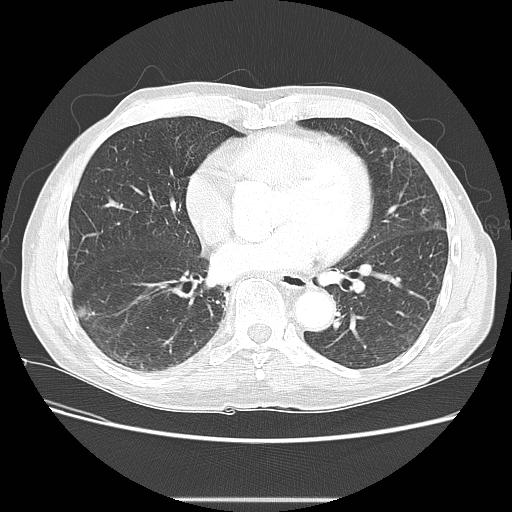 Bronchocele (Radiopaedia 17097-16795 Axial lung window 73).jpg
