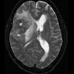 File:Bronchogenic carcinoma brain metastasis (Radiopaedia 9286-9969 Axial T2 1).jpg