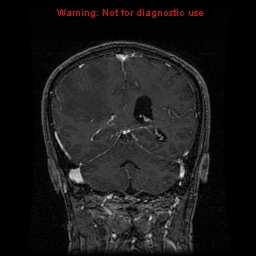 File:Bronchogenic carcinoma brain metastasis (Radiopaedia 9286-9969 Coronal T1 2).jpg