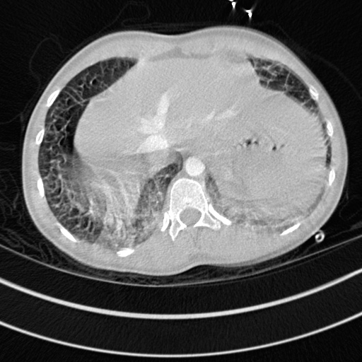Bronchogenic cyst (Radiopaedia 77801-90071 Axial lung window 76).jpg