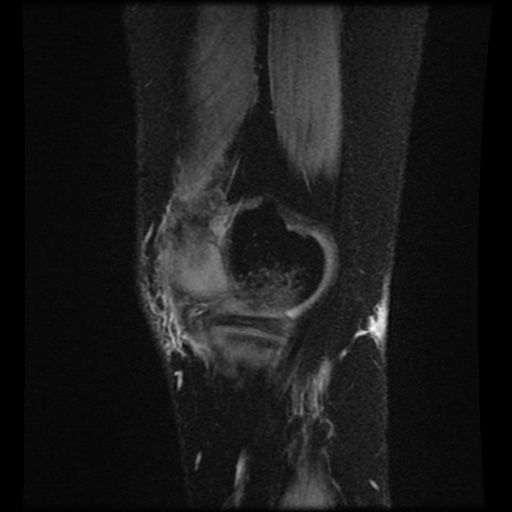 Bucket handle meniscus tear (Radiopaedia 56916-63751 H 76).jpg