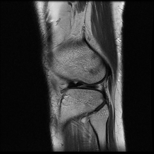 File:Bucket handle meniscus tear (Radiopaedia 56916-63751 Sagittal T2 4).jpg