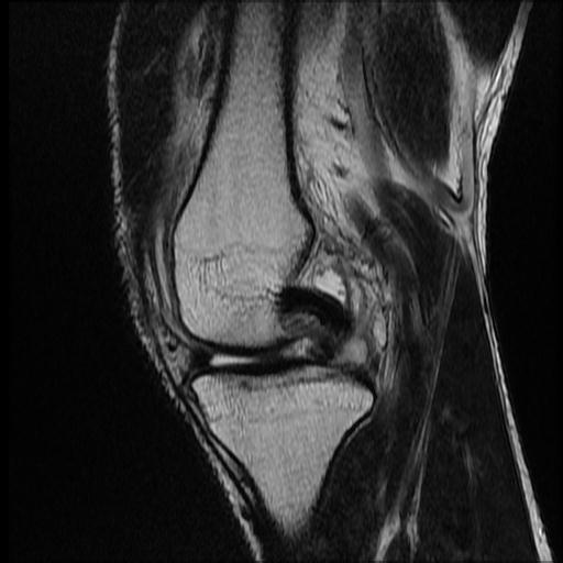 File:Bucket handle tear - medial meniscus (Radiopaedia 69245-79026 Sagittal T2 12).jpg