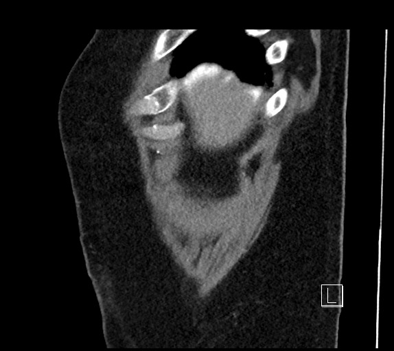 Buried bumper syndrome - gastrostomy tube (Radiopaedia 63843-72577 Sagittal Inject 112).jpg