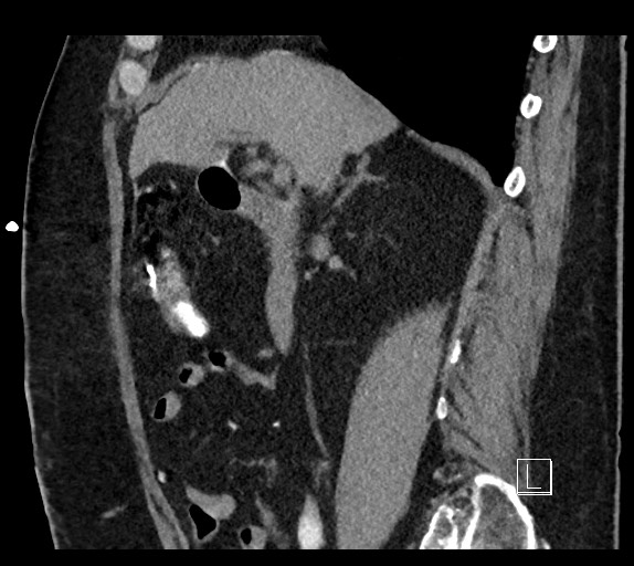 Buried bumper syndrome - gastrostomy tube (Radiopaedia 63843-72577 Sagittal Inject 76).jpg