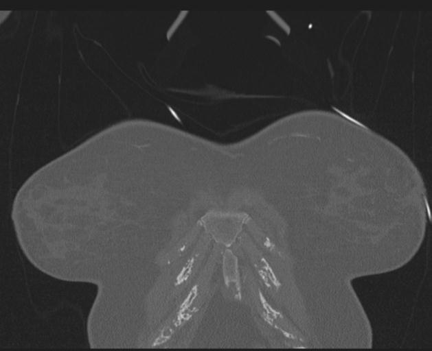 File:Burst fracture - thoracic spine (Radiopaedia 30238-30865 Coronal bone window 16).jpg
