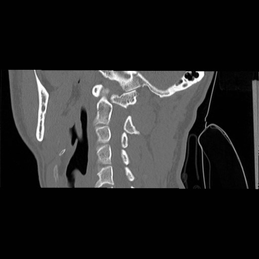 File:C1-C2 "subluxation" - normal cervical anatomy at maximum head rotation (Radiopaedia 42483-45607 C 40).jpg