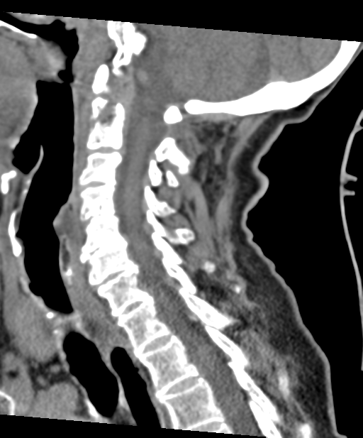 C2 fracture with vertebral artery dissection (Radiopaedia 37378-39199 D 36).png