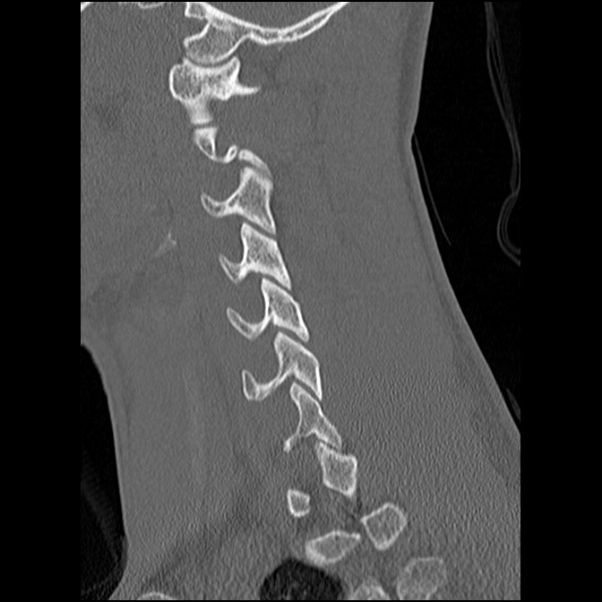 C5 facet fracture (Radiopaedia 58374-65499 Sagittal bone window 48).jpg