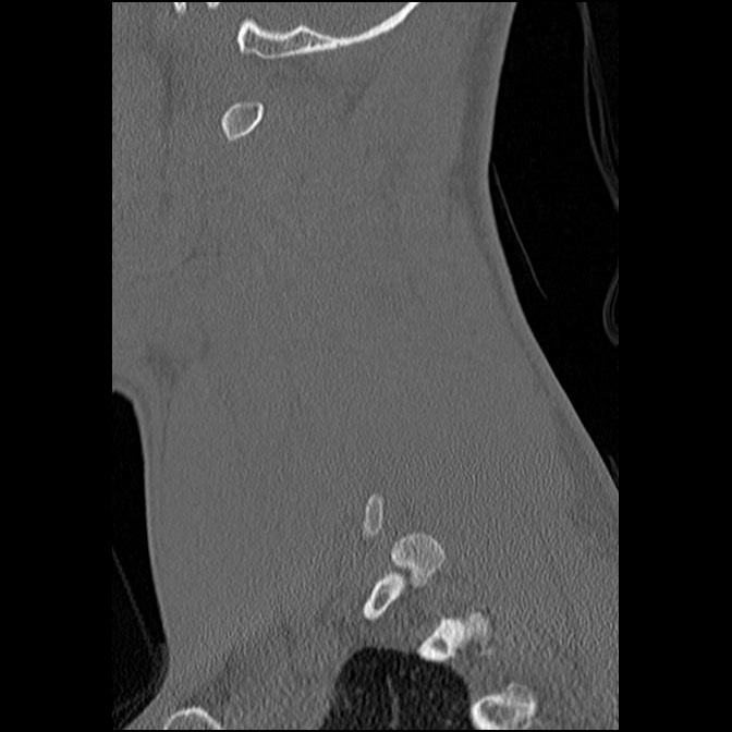 C5 facet fracture (Radiopaedia 58374-65499 Sagittal bone window 53).jpg