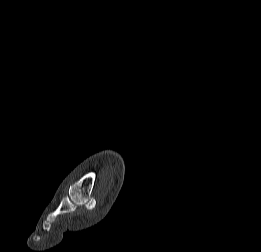 Calcaneal fracture - Sanders type 4 (Radiopaedia 90179-107370 Sagittal bone window 13).jpg