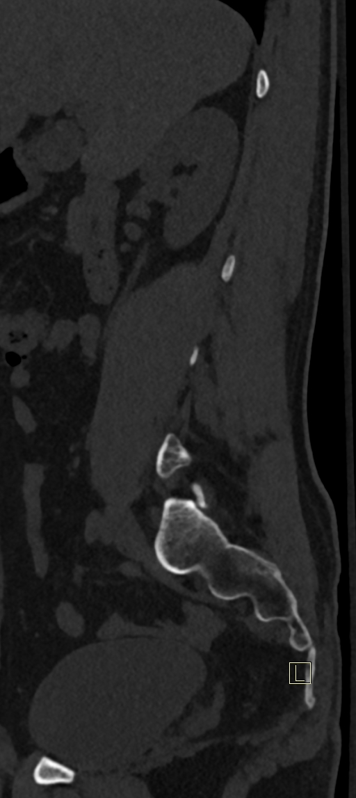 Calcaneal fractures with associated L2 burst fracture (Radiopaedia 71671-82493 Sagittal bone window 67).jpg