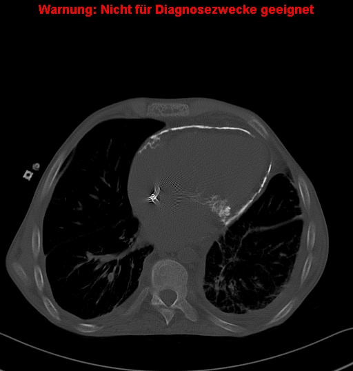 File:Calcific constrictive pericarditis (Radiopaedia 24701-24967 Axial bone window 20).jpg