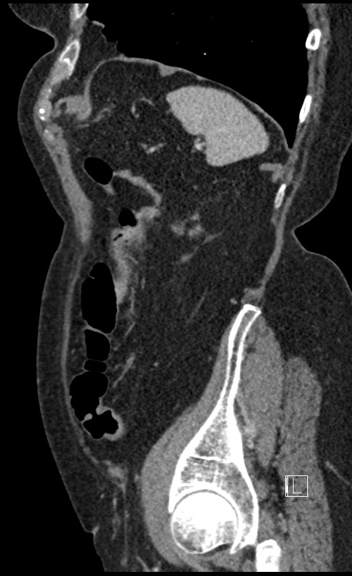 Calcified adrenal glands and Spigelian hernia (Radiopaedia 49741-54988 C 32).jpg