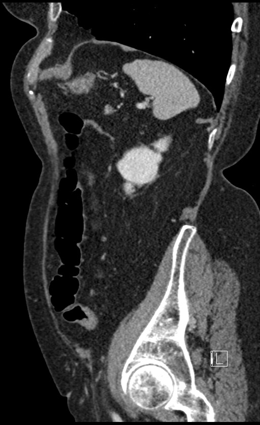 Calcified adrenal glands and Spigelian hernia (Radiopaedia 49741-54988 C 35).jpg