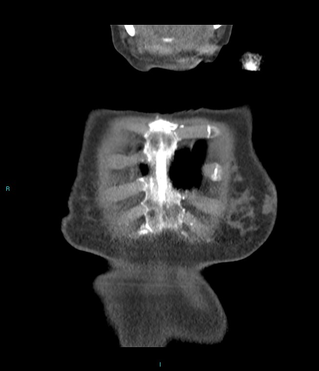 Calcified cerebral emboli from left ventricular thrombus (Radiopaedia 84420-99760 Coronal C+ CTPA 68).jpg