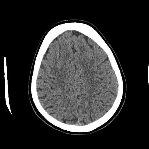 Calcified cerebral hydatid cyst (Radiopaedia 65603-74717 Axial non-contrast 58).jpg