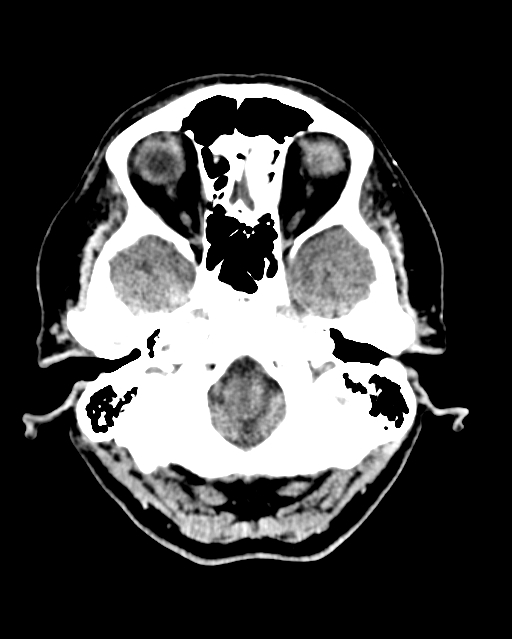 Calcified meningioma (Radiopaedia 74361-85243 Axial non-contrast 43).jpg