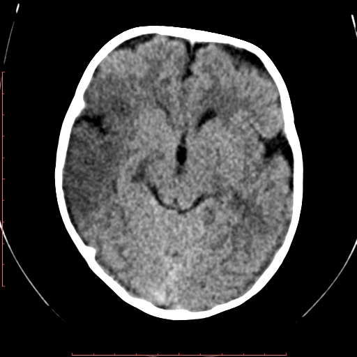 File:Calcified middle cerebral artery embolism (Radiopaedia 78949-91860 Axial non-contrast 11).jpg