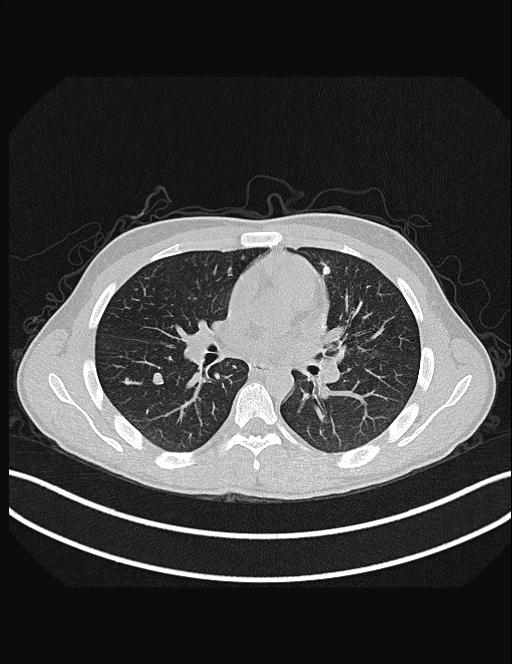Calcifying pulmonary metastases (Radiopaedia 33359-34396 Axial lung window 31).jpg